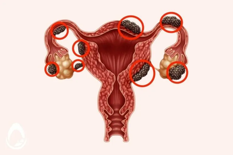 ENDOMETRIOSIS