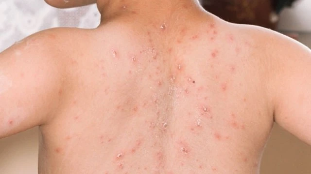 Perbedaan cacar dan campak