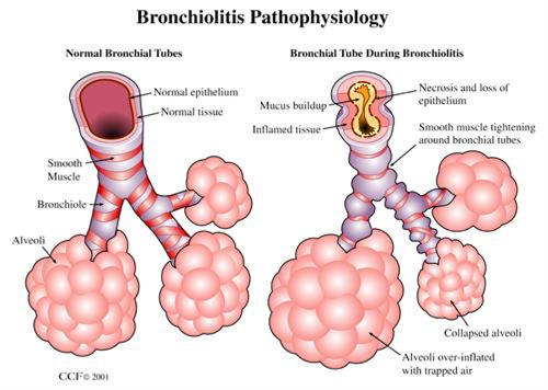 Bronkiolitis Pada Bayi