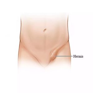 Hernia pada anak - KMNC