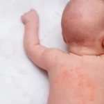 biang keringat pada bayi