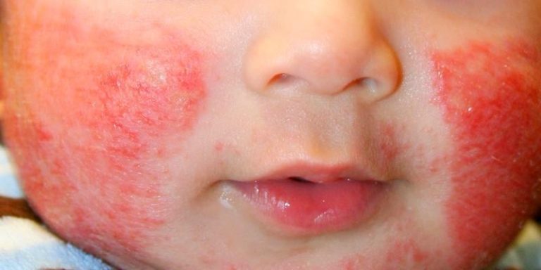 dermatitis atopi pada anak